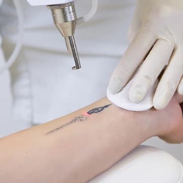 Tattoo Removal